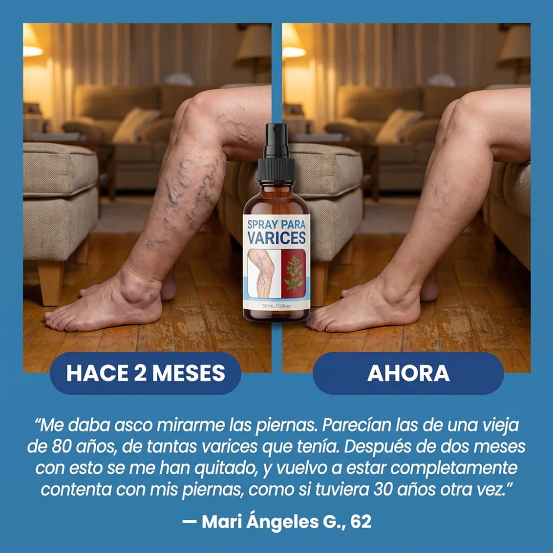 Spray de Crioterapia para Eliminar la Aparición de Varices y Arañitas