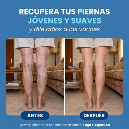 Spray de Crioterapia para Eliminar la Aparición de Varices y Arañitas